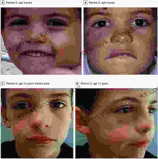 Parry Romberg Syndrome: A Progressive Hemifacial Atrophy What To Know About Parry Romberg Syndrome A K A Progressive Hemifacial Atrophy? (A Concise Overview Of A Poorly Understood Entity )