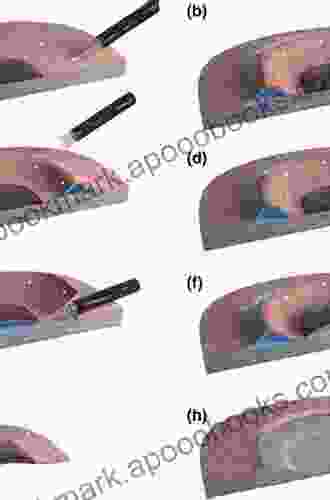 Endoscopic Submucosal Dissection: Principles and Practice